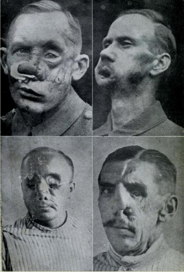 Plastic surgery in WWI