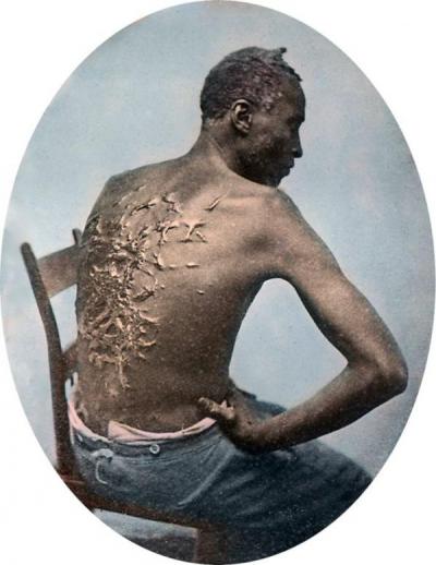 1863. Fotografia di Gordon, schiavo fuggiasco da una piantagione nel Mississippi