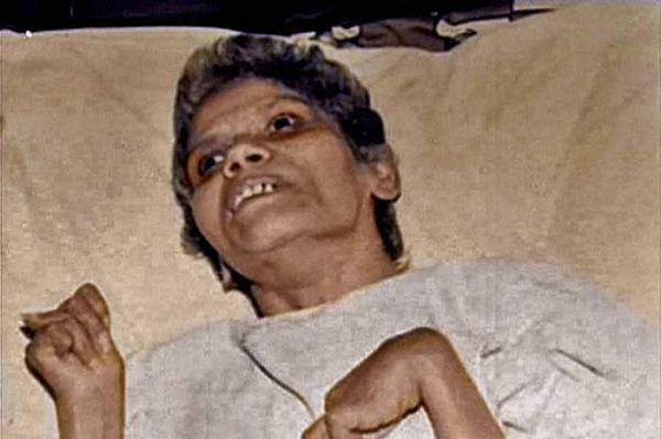 Aruna Shanbaug