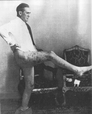 Graziani mostra le ferite di guerra