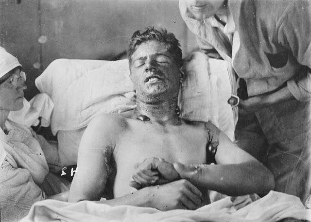 Soldat canadien avec brûlures et ampoules causées par l'ypérite (ca. 1917-18)