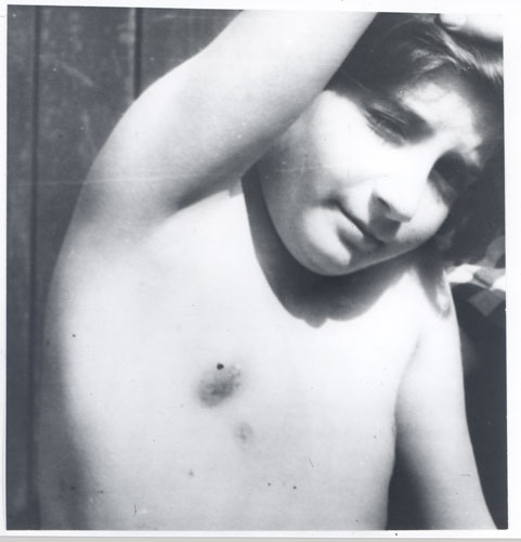 H. Wassermann, 8 anni, polacca, dopo la rimozione dei linfonodi