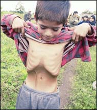 Provincia del Chaco, Argentina. Bambino denutrito