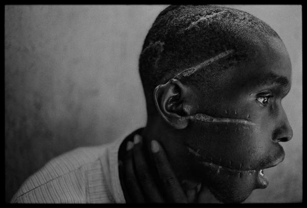 Le ferite inflitte ad un giovane Hutu rifiutatosi di prendere parte ai massacri, foto di James Nachtwey.
